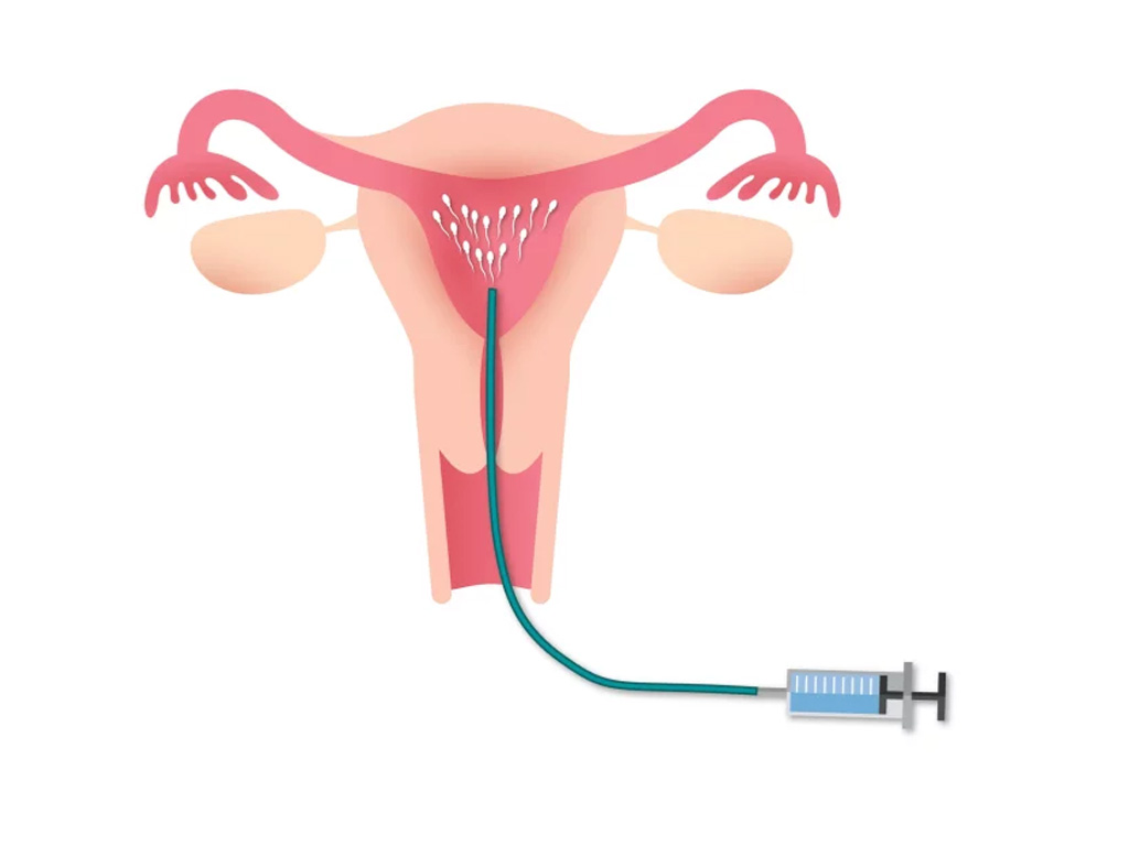 인공수정 이미지